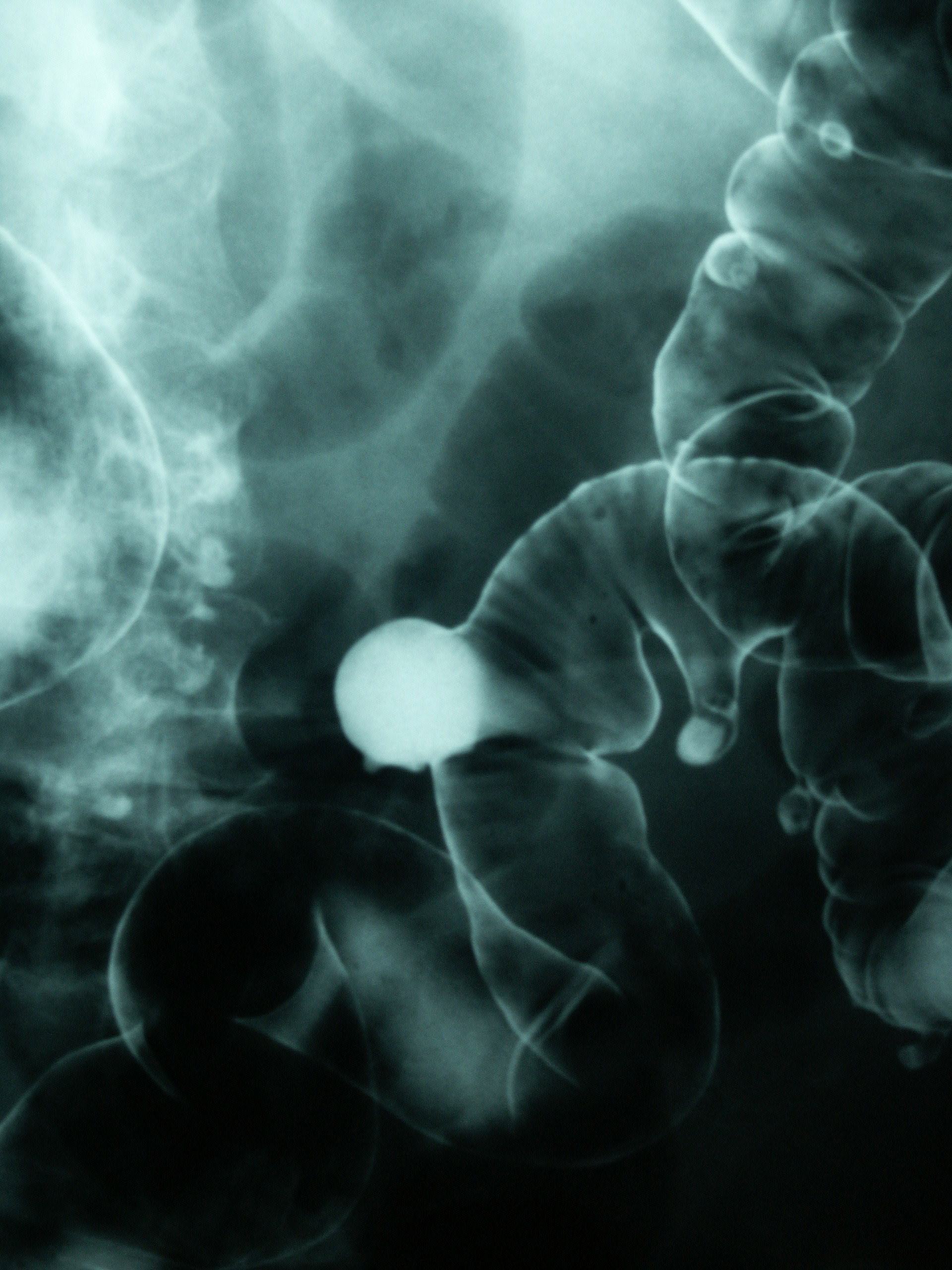 colon polyp